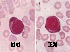 缺铁性贫血