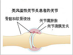 类风湿关节炎