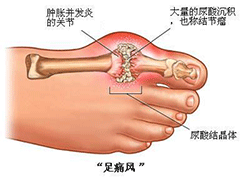 痛风