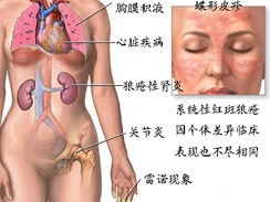 系统性红斑狼疮