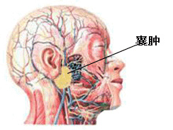 皮脂腺囊肿