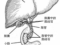 胆结石