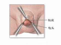 包皮龟头炎