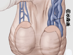 精索静脉曲张