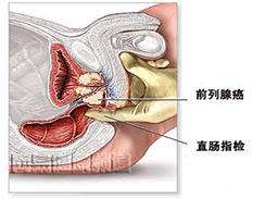 前列腺癌