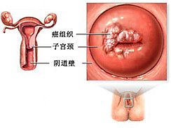 宫颈癌