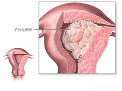 子宫内膜癌