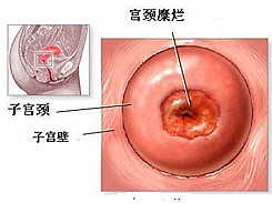 宫颈糜烂