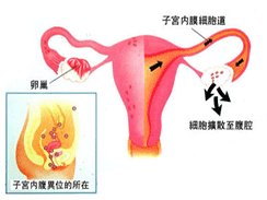 子宫内膜异位症