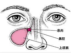鼻窦炎