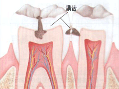 龋齿