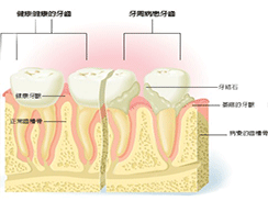 牙周病