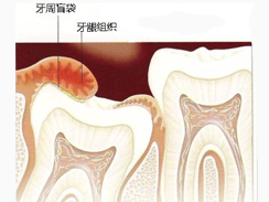 智齿冠周炎