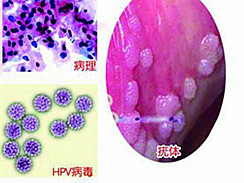 尖锐湿疣