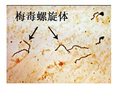 软下疳