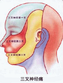 合肥三叉神经痛