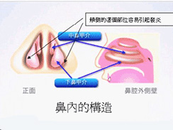 慢性鼻炎