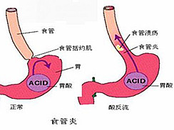 反流性食管炎图集