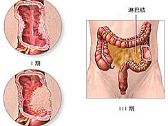 结肠癌图集