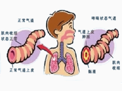 支气管哮喘