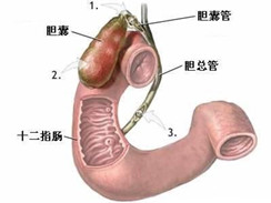 胆囊结石图集