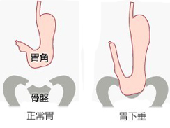 胃下垂