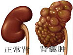 肾囊肿图集