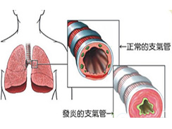 支气管炎