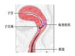 阴道炎