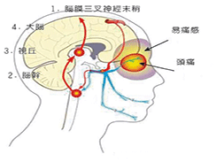 偏头痛