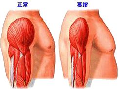 重症肌无力