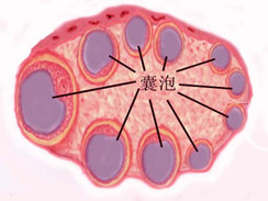 多囊卵巢综合征