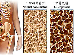 骨质疏松