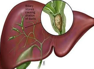 肝内胆管结石
