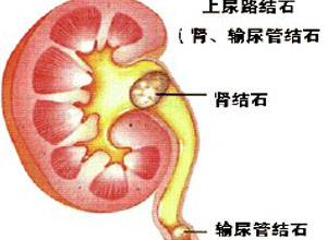 高草酸尿