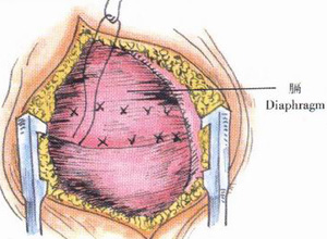 膈肌缺损