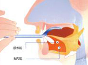 构音障碍