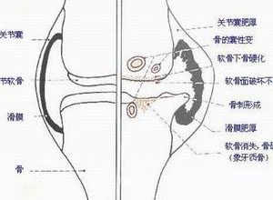 滑膜发炎