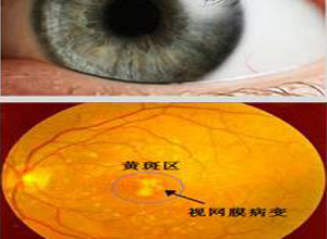 黄斑回避现象