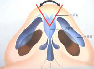 鼻翼上方缺损