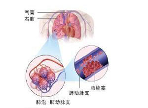 空气栓塞