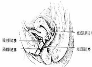 便稀时经阴道排出