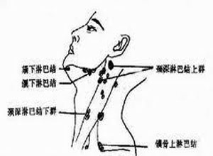 淋巴管破裂