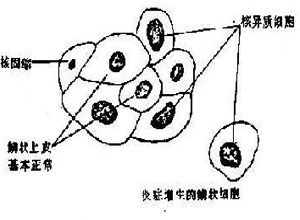 鳞状细胞化生