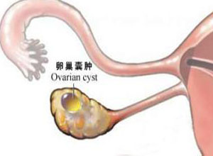 卵巢囊肿