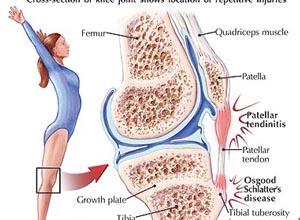 髌后疼痛