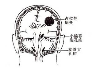 脑疝