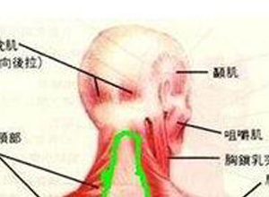 脖子扭痛