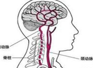 脑血管痉挛