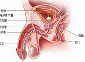 尿道变粗变硬